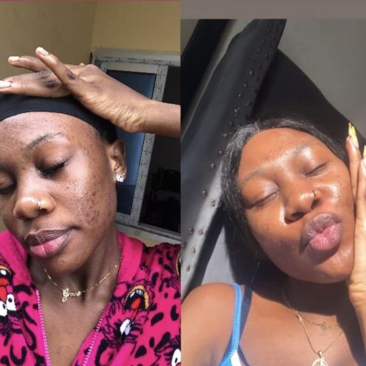 Savon Kojie San : Éclat Naturel, Peau Nette, Fraîche & Éclatante