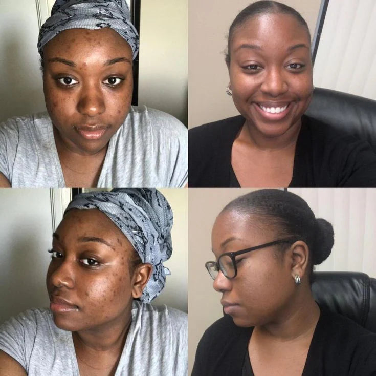 Sérum à l’Acide Kojic,Anti-Taches, Éclaircissant & Unifiant contre la Pigmentation Visage et Corps