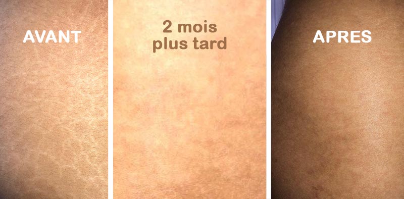 Crème Anti-Cicatrice, vergeture, chéloïde