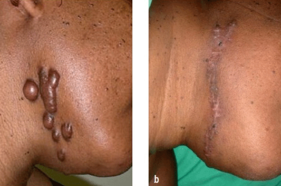 Crème Anti-Cicatrice, vergeture, chéloïde