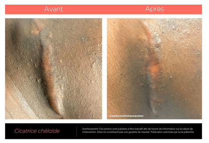 Crème Anti-Cicatrice, vergeture, chéloïde